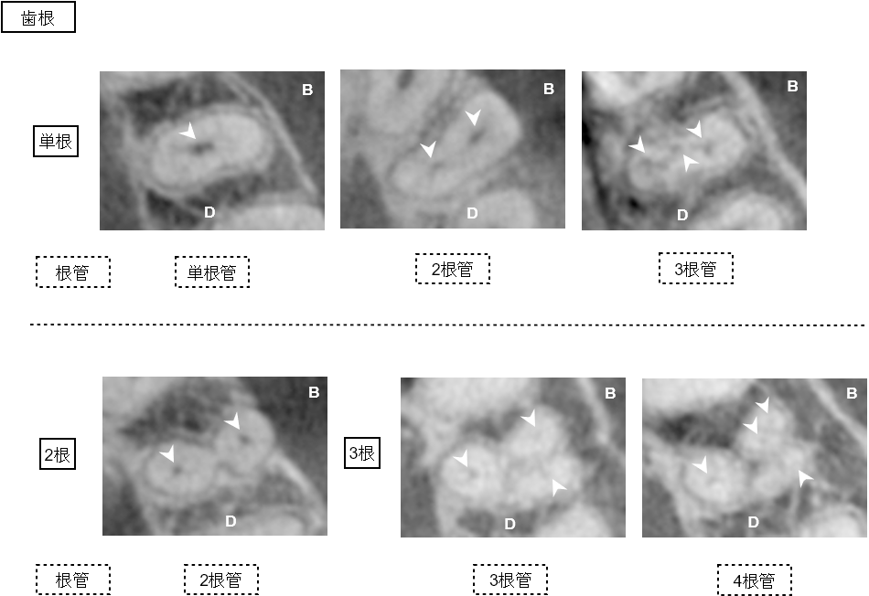 上顎小臼歯における歯根数と根管数