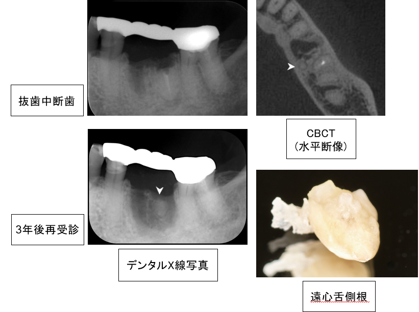 遠心舌側根（矢頭）の残遺