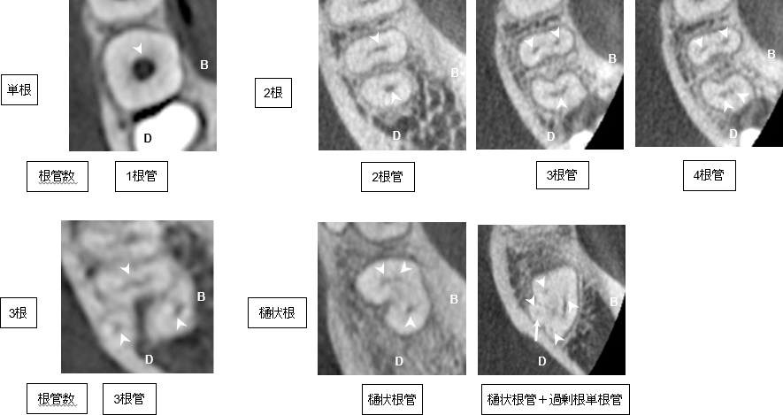 下顎第二大臼歯における歯根数と根管数