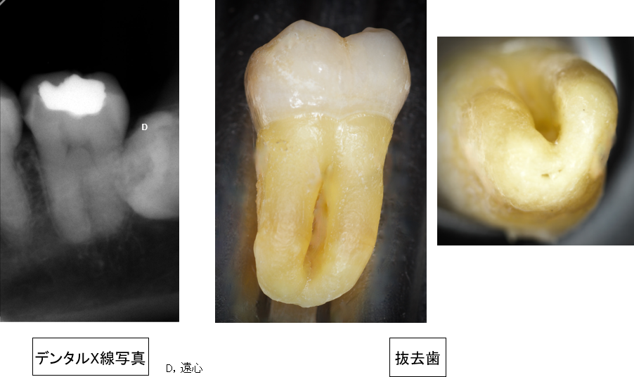 樋状根