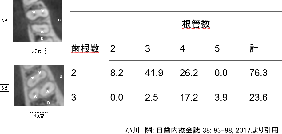 下顎第一大臼歯における歯根と根管数の頻度