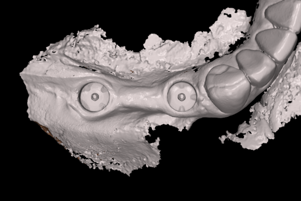図14：口腔内スキャナーによる光学印象で製作されたインプラントブリッジ