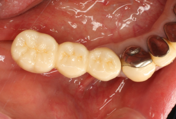 図14：口腔内スキャナーによる光学印象で製作されたインプラントブリッジ